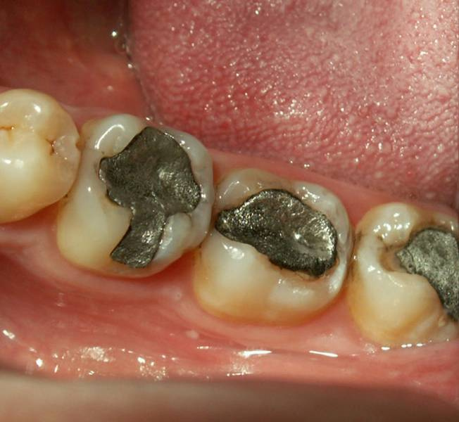 Amalgamfüllung Zahnärzte Thorsten Mielke & Kollegen in Hamburg Eimsbüttel